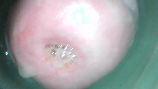 After all the sounding, time to clean up! I used a catheter to rinse out my cervix