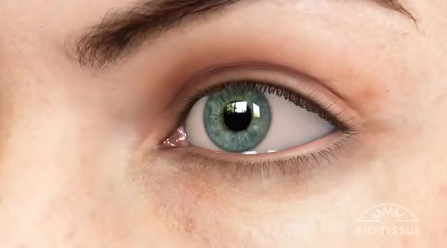 Conjunctivochalasis (CCH) Dry Eye Animation