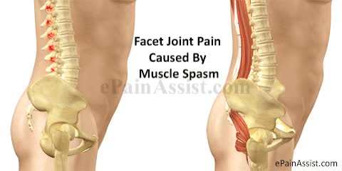 Facet Joint or Zygapophysial Joint Pain - ePainAssist.com