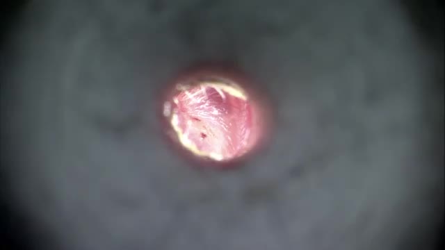 myringotomy-edited