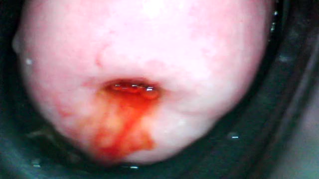 I tried to make my cervix less spicy before moving on to my next plan... (slight